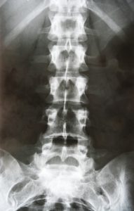 SCI Injuries require a Spinal Cord Injury Lawyer