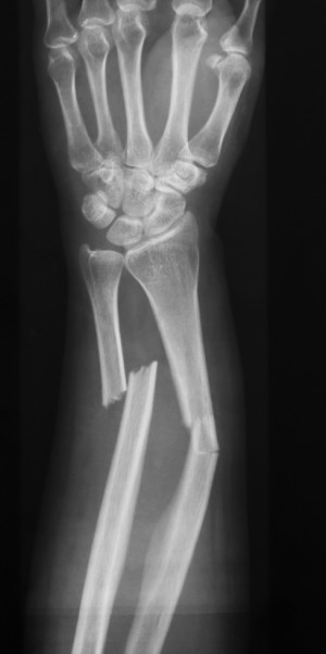 X-ray image of forearm